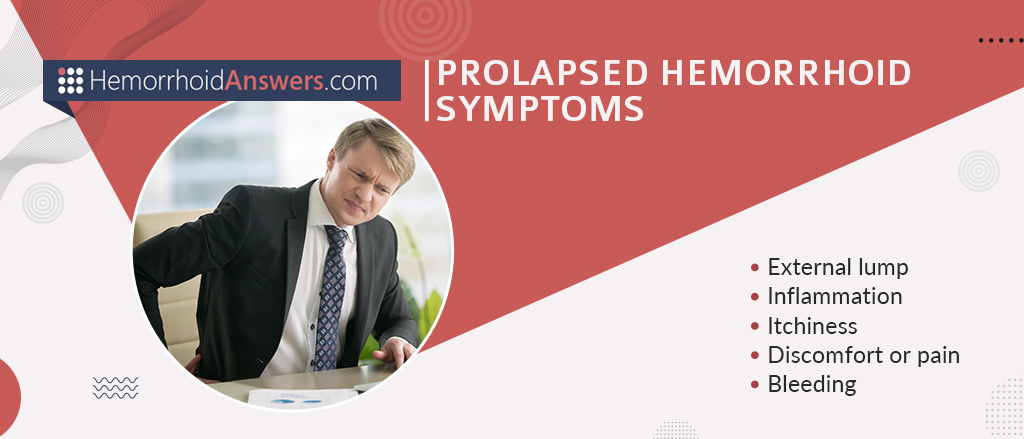 Prolapsed Hemorrhoids